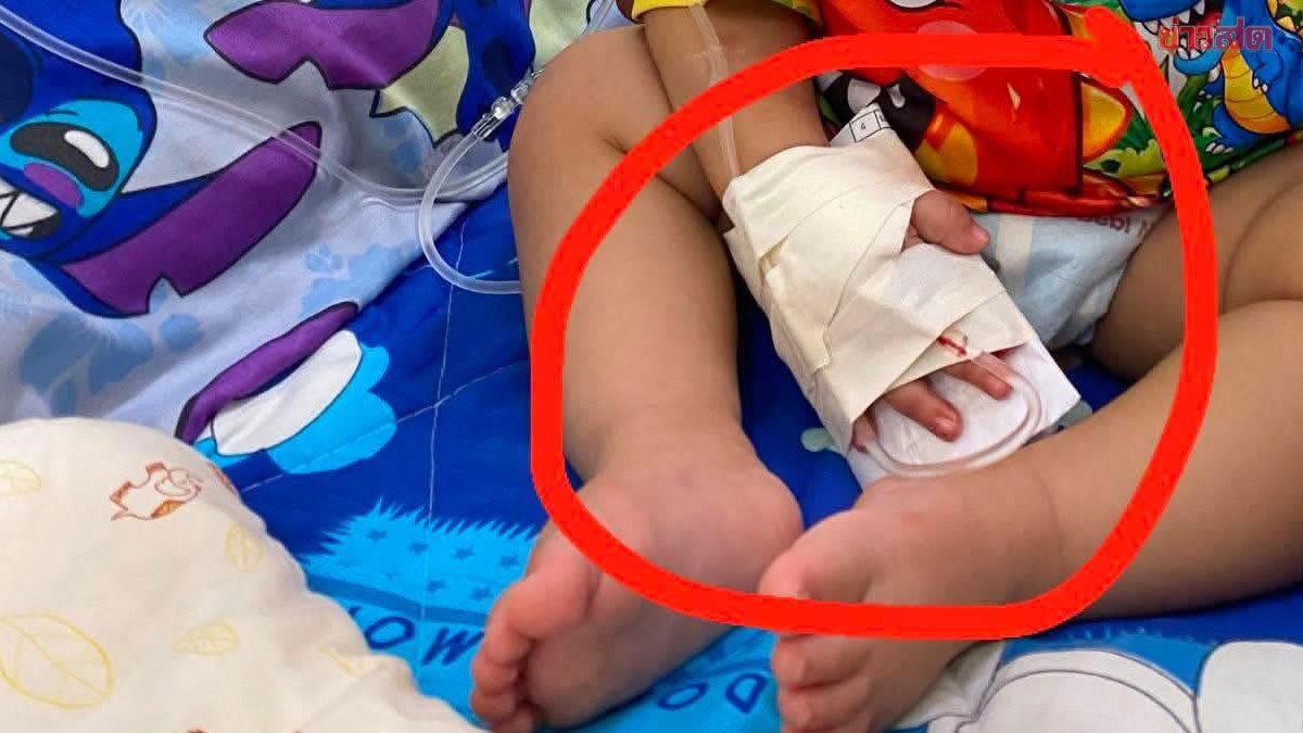 Medical Error Leads to Amputation of Toddler's Finger in Thailand