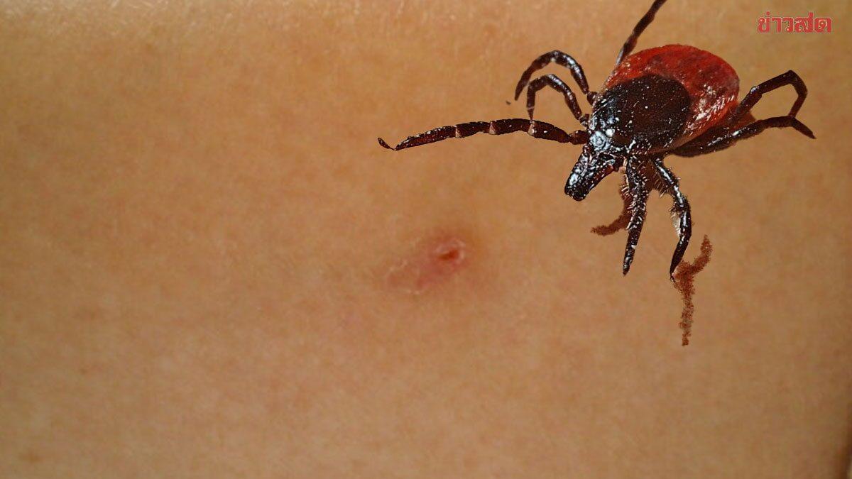Thai Health Authorities Monitor Tick-Borne Viral Fever