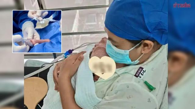 Sopravvivenza miracolosa: neonato prematuro prospera dopo la nascita a 330 grammi