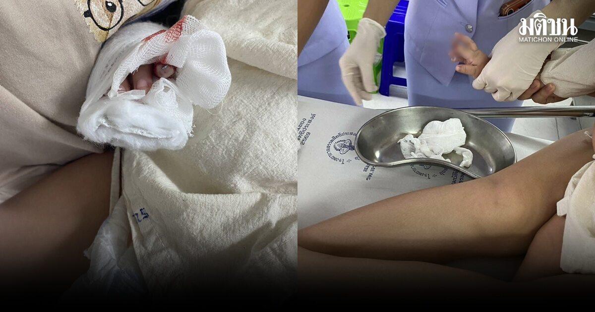 Dibattito sulla sicurezza medica: l'uso di forbici nella rimozione di flebo pediatriche