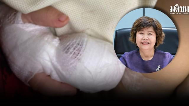 NHSO Clarifies Compensation Status for 'Nong Ufa' Case