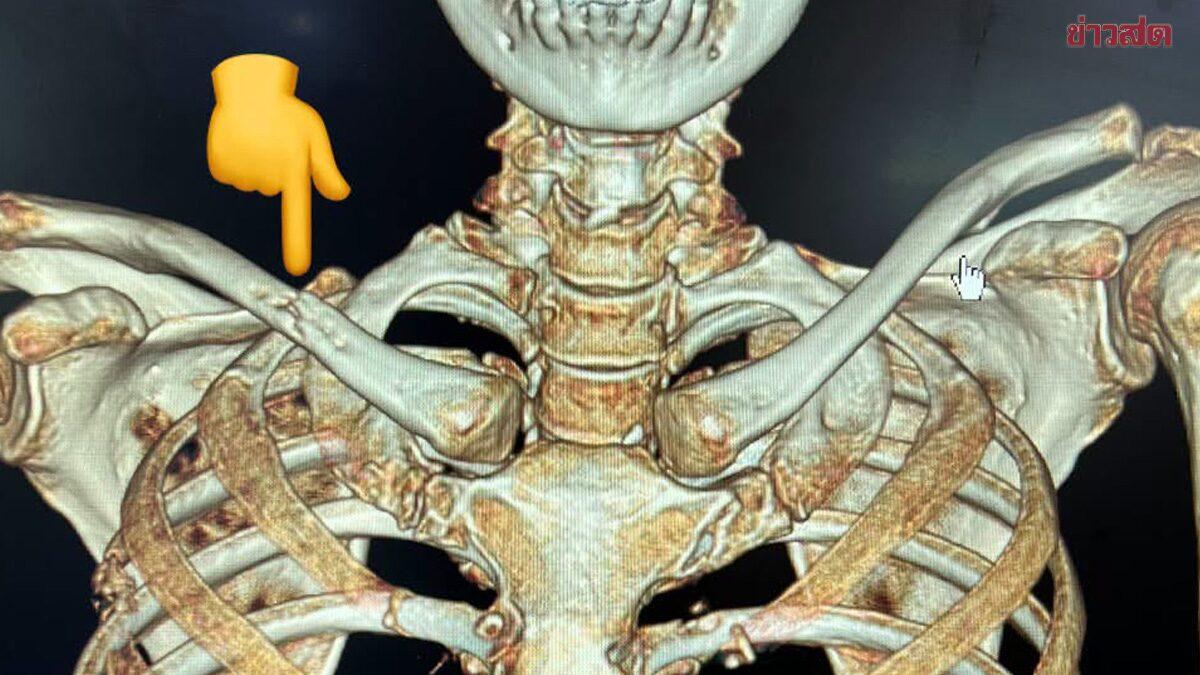 Doctor Highlights Lung Cancer Case Presenting as Bone Pain
