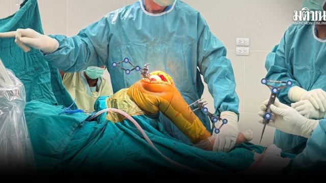 Nopparat Rajathanee Hospital Introduces Robotic Knee Replacement Surgery