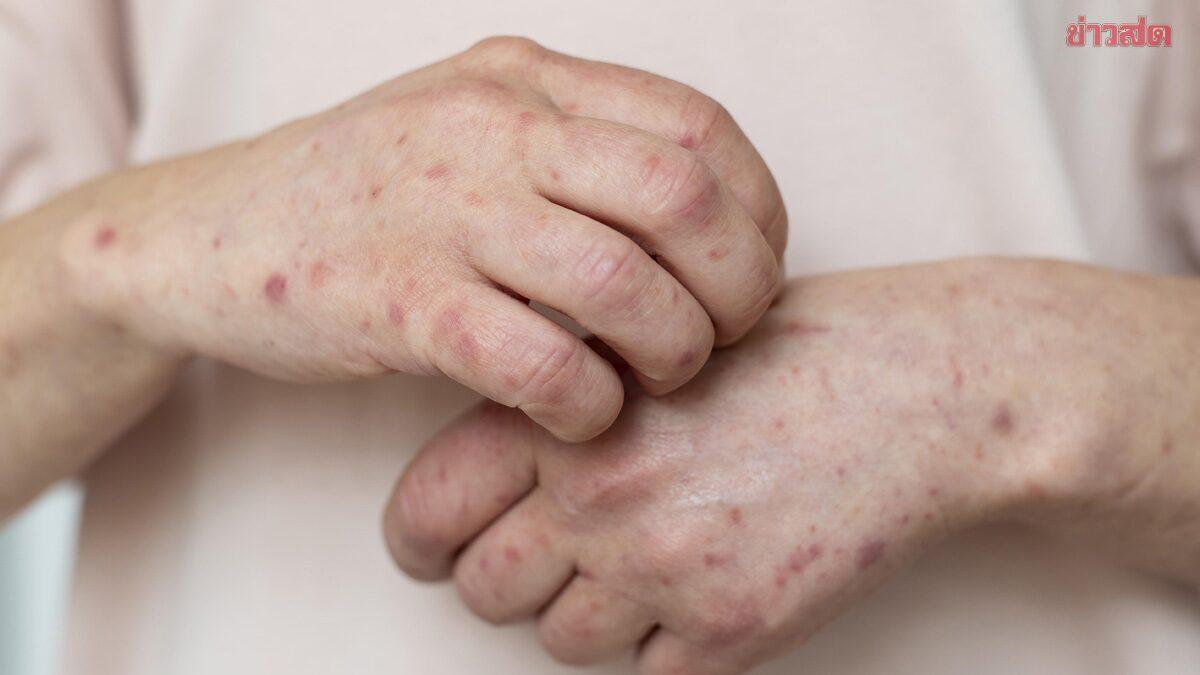 Doctor Reports Secondary Syphilis Case in HIV-Positive Patient