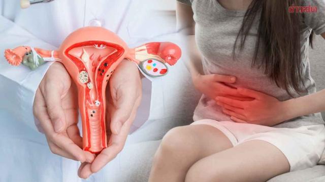 Medical Expert Warns of Subtle Ovarian Cancer Symptoms