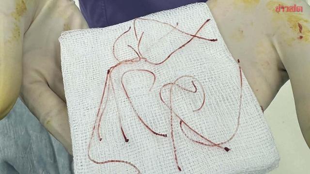 Une clinique de beauté de Phatthalung fait face à des plaintes pour faute professionnelle présumée