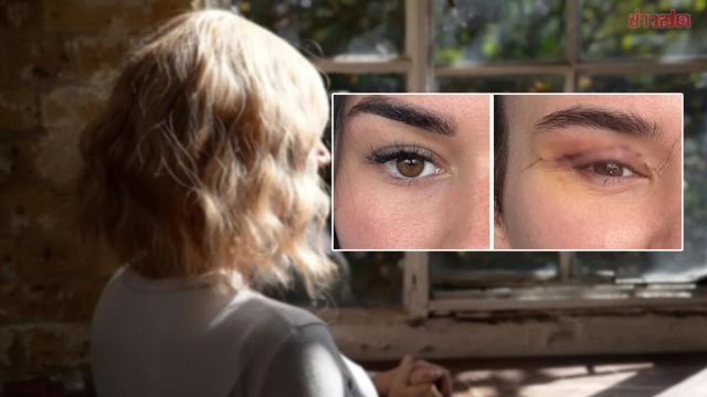 Warning Issued Over Risks of Low-Cost Eyelid Surgery